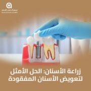 زراعة الأسنان الحل الأمثل لتعويض الأسنان المفقودة