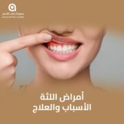 أمراض اللثة الأسباب والعلاج